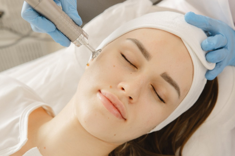 Лазерный пилинг